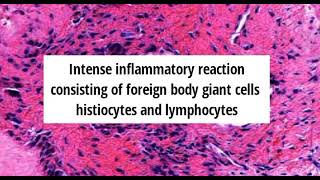 Pathology of Gouty Tophus by Dr Sampurna Roy MD