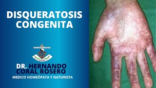 DISQUERATOSIS CONGENITA