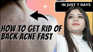 Back and body acne treatment | how to get rid of acne | fixderma-salyzap…