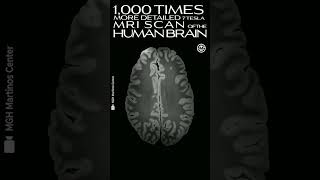 1000 Times more Detailed 7 Tesla MRI Scan of the Human Brain #brain #shorts #tesla #medical