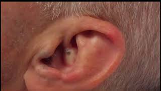 26 Ear Blackhead Extraction Extravaganza #advanceddermatologyseattle com#viral