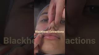 BLACKHEAD EXTRACTIONS