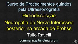 Intervenção guiada pelo Ultrassom - Hidrodissecção do nervo interósseo posterior - Cotovelo