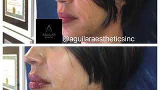 Lip Augmentation with Dermal Fillers - Aument Labial con Ácido Hyaluronico