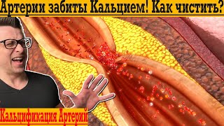 Артерии забиты КАЛЬЦИЕМ! Как убрать КАЛЬЦИНОЗ?!