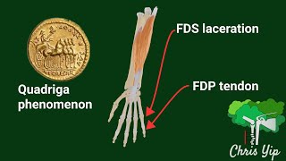 Flexor tendon injuries and the Quadriga Phenomenon (animated)