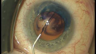 Cataract Extraction + Canaloplasty in Setting of Long Anterior Zonules  (Malik Y. Kahook, MD)