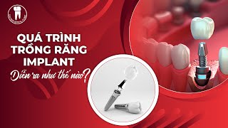 Quá trình trồng răng Implant diễn ra như thế nào? | Nha khoa Đại Nam