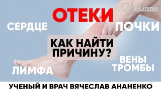 ОТЕКИ, как найти причину? Сердце, почти, лимфа, вены, тромбы