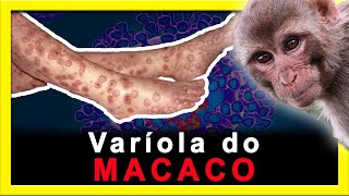 VARÍOLA DO MACACO. Mais uma doença para nos preocupar?