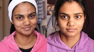 How I Got Rid Of My Acne ft. PMD | Zahrah Aliyah