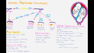 Multiple Pregnancy (Twins, Triplets) - Zygosity, Chorionisity, Amnionisity, Risks, Delivery