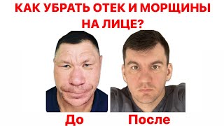 Навсегда убрал отек на лице и морщины и стал на столько красивым что женился на королеве Англии