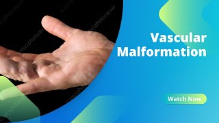 Vascular Malformation