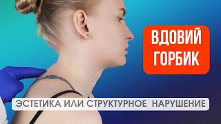 Два лучших упражнения от вдовьего горбика