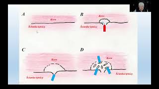 Wykład 61. Biomineralogia blaszki miażdżycowej.(Biomineralogy of atherosclerotic plaque)