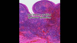 Histopathology of Branchial Cleft Cyst #shorts #pathology #dermpath