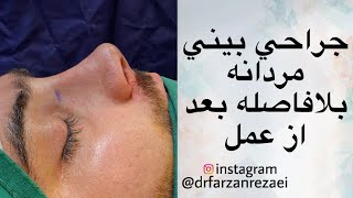 ‎جراحی بینی مردانه شیک به روش بسته و کم تهاجمی‎‏‎ بلافاصله بعد از عمل