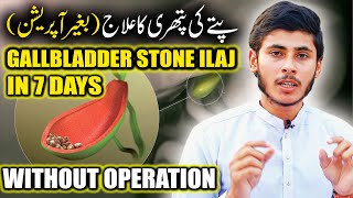 How To Remove Gallladder Stone Treatment Without Operation | Pittay Ki Pathri Ka ilaj