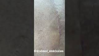 شكل جرح شد البطن بعد ٣ شهور من العمليه …Abdominoplasty scar