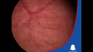 Ureteroscopic Lithotripsy (URS) and Bladder Stone Dr. Ali Mehdi Zadeh Consultant Urologist in Kuwait