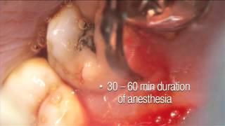 Cetacaine Subgingival Application Demo