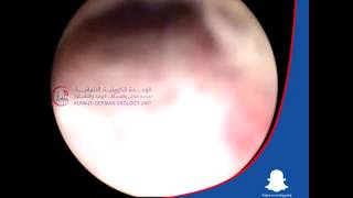 Cystoscopy for Female -  Dr. Ali Mehdizadeh Consultant Urologist in Kuwait