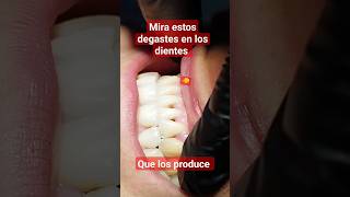 Desgaste en tus dientes puede ser tu caso😭y no sabes por qué se produce y no es por un mal cepillado