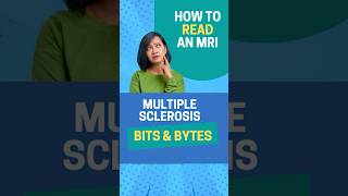 MRI Made Simple: Spotting Multiple Sclerosis signs 🎯#mutliplesclerosis #msdiagnosis