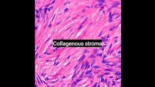 Histopathology of Dermatofibrosarcoma protuberans #dermpath  #dermatopathology #shorts