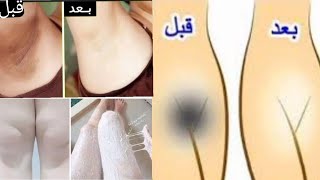 أسرع وصفه لتفتيح المناطق الحساسة قبل الزفاف تبييض فورى المناطق الحساسة بين الفخذين 😱ستدهشك النتيجة