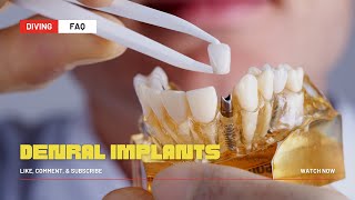 Dental Implants