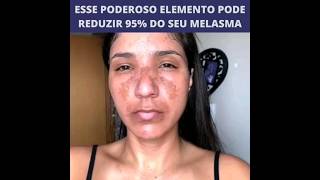 Depoimento de quem sofria com melasma a anos ! Tenha a pele saudável e sem manchas você também !