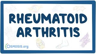 Rheumatoid arthritis - causes, symptoms, diagnosis, treatment, pathology