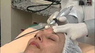 Peeling de Diamante - Dr. Marco Cesar Valle - www.midas.med.br