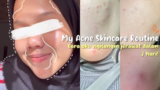 My Acne Skincare Routine | Cara ngilangin jerawat instan dengan Erha Acne Act!