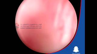 أفضل دكتور مسالك بولية في الكويت Urethroscopy - Dr. Ali Mehdi Zadeh Consultant Urologist in Kuwait