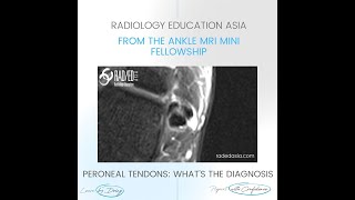 WHAT'S THE DX: ANKLE PERONEUS BREVIS SPLIT