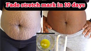 STRETCH mark Removal🔥/ How to get of stretch mark #scar #stretchmark