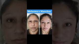 O queridinho do skincare perfeito #melasma #pele #beleza #skincare #manchasnapele