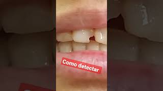 Caries debajo de las calzas o resinas dañan tu diente natural hasta q duela  suscríbete  🦷