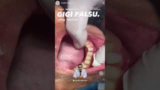 CARA MENGATASI GIGI PALSU LONGGAR ‼️#caramengatasigigipalsulonggar #gigipalsu