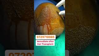 Immediate After Hair Transplant Surgery | High Density Hair Transplant #shorts #hair #hairtransplant