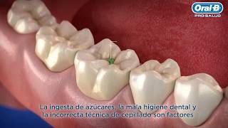 ¿Que es la caries?