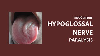 Tongue deviation in hypoglossal nerve palsy | Neuroanatomy | Cranial Nerves | medCampus