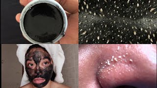 Masque au charbon contre les points blancs et imperfections du visage