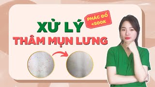 MỤN LƯNG - THÂM MỤN, Phác đồ điều trị chưa tới 500k  | Ngọc Nguyễn