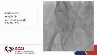 Complex PCI Female Case by Dr Anbukarasi Maran