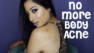 HOW TO GET RID OF BODY ACNE (Luminosity Acne Skincare)