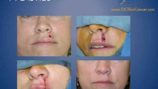 Lip and Chin Reconstruction